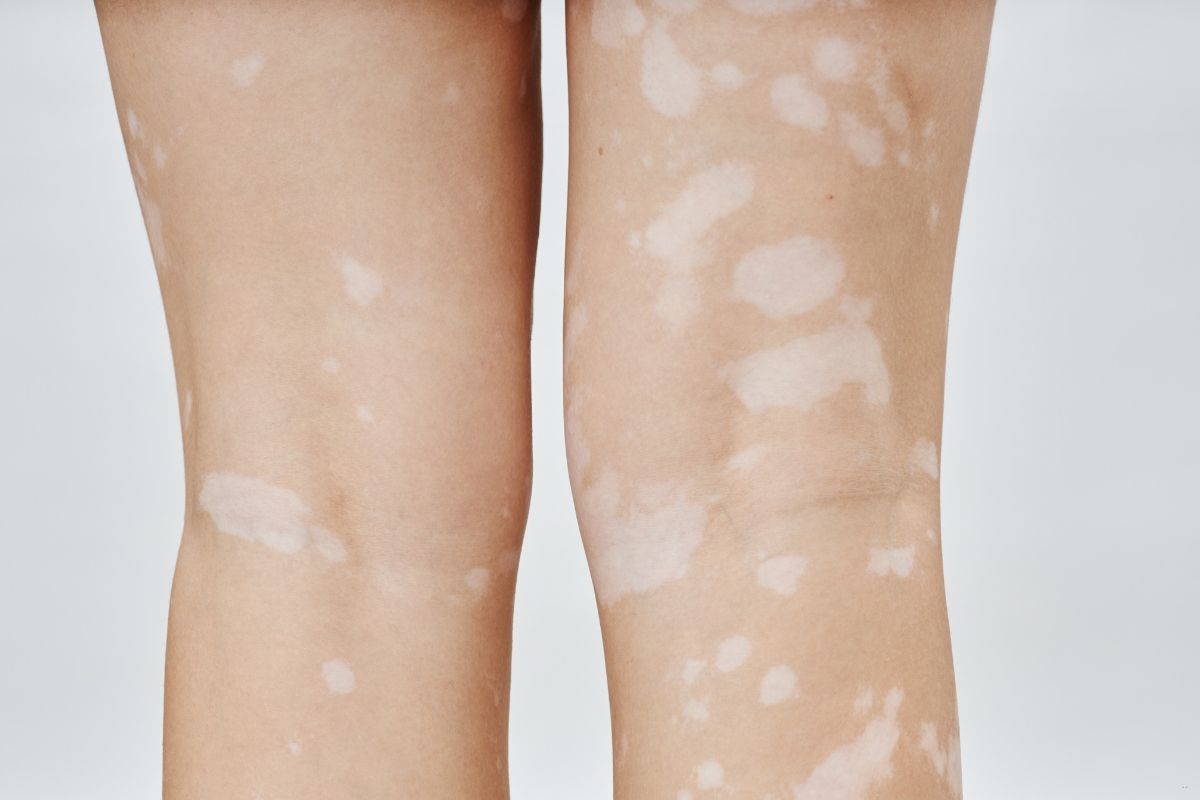especialista-en-vitiligo-en-santa-cruz-de-la-sierra